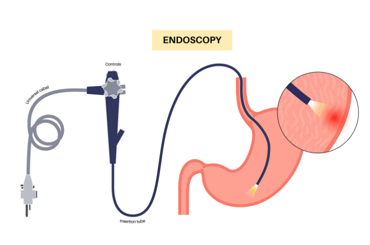 Endoscopy