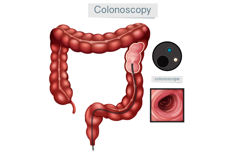 Colonoscopy